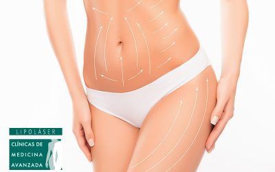 ¿Es eficaz la liposucción mediante láser?